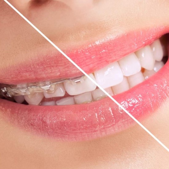Invisalign (Ortodoncia Invisible)